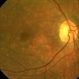Choroidal Infarcts Preeclampsia Choroidal Infarcts Preeclampsia